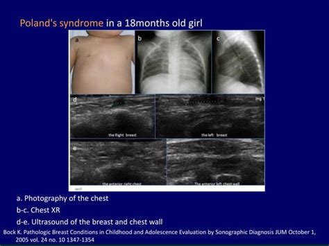 undeveloped tits|Pediatric and adolescent breast hypoplasia